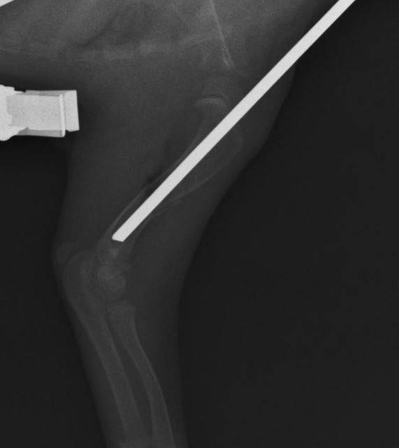 ピンを骨折部に挿入した部分のレントゲン写真.jpg