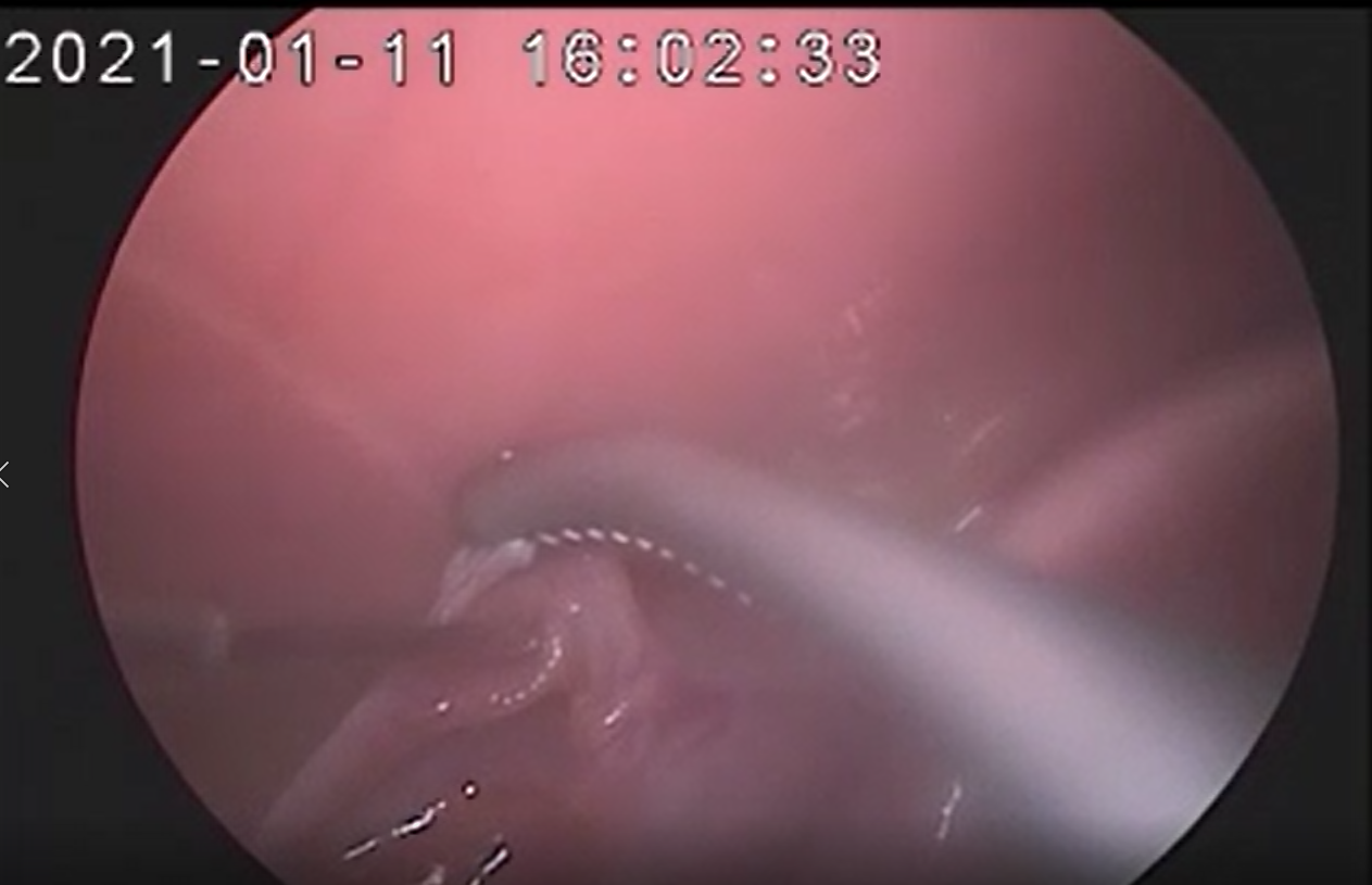 腹腔鏡注入.png